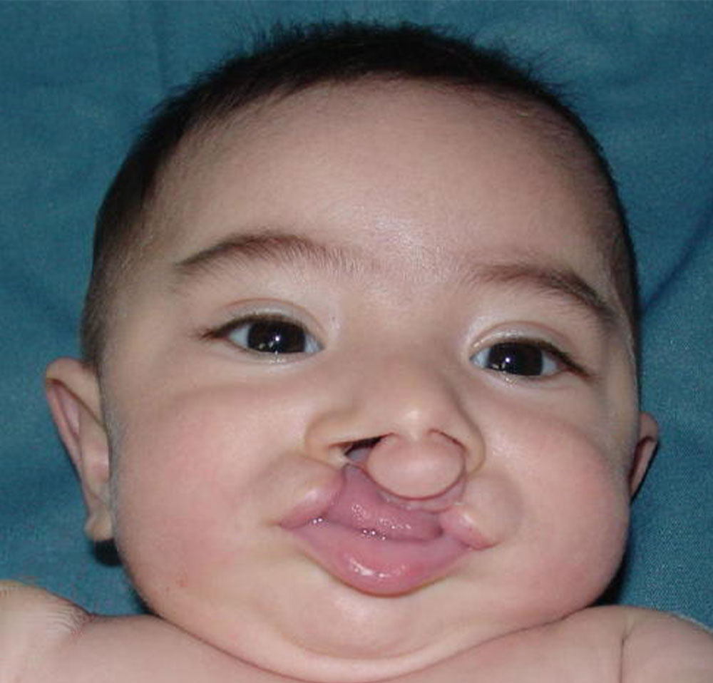 Maximiliano before cleft surgery