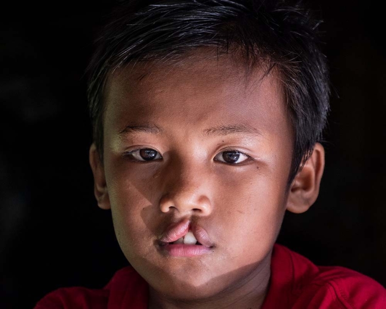 Rajib antes da cirurgia de fissura labial